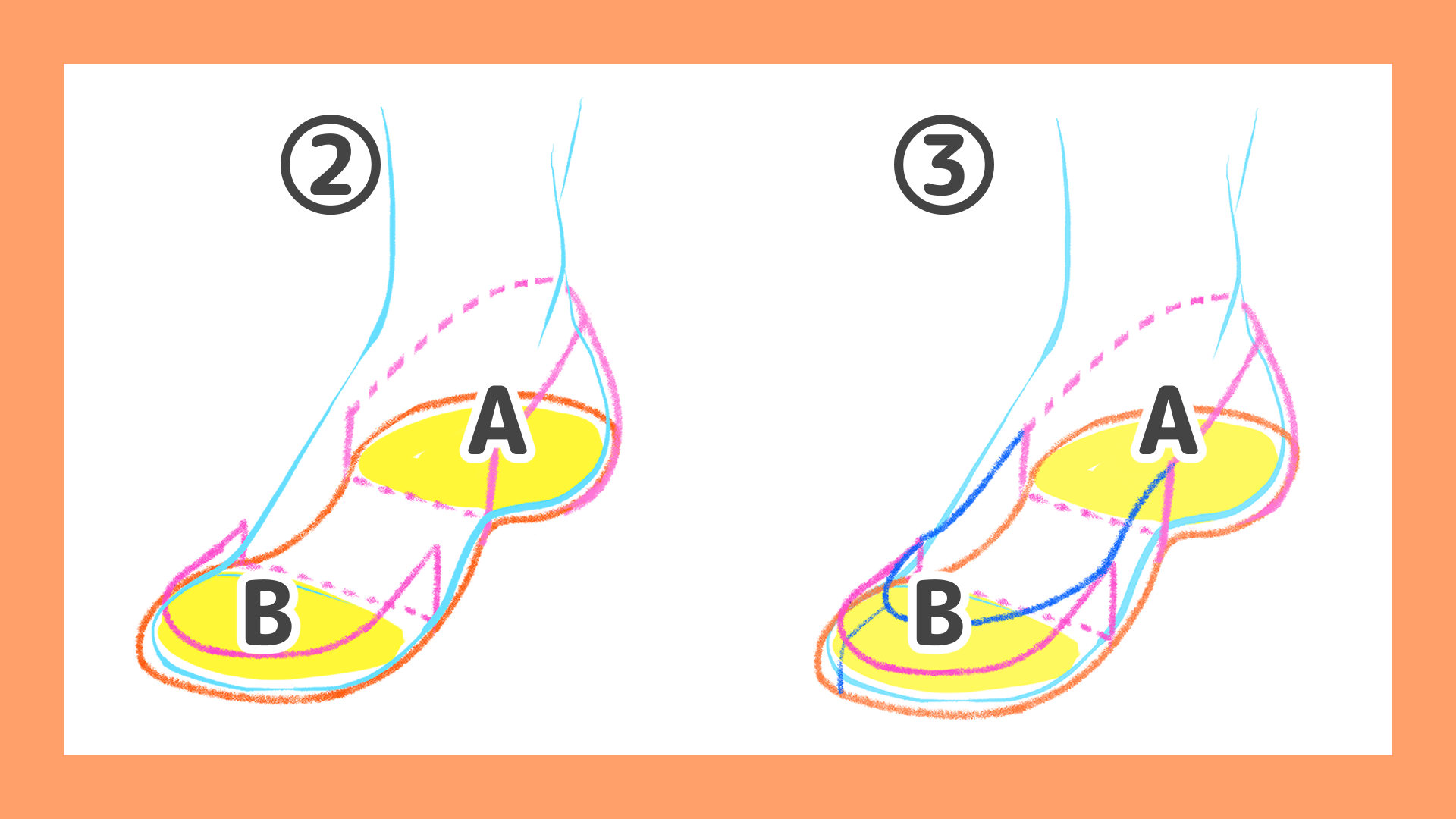 足と靴のアタリ